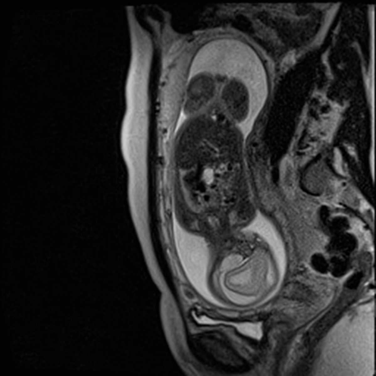 Fetal diaphragmatic hernia - CTisus CT Scan