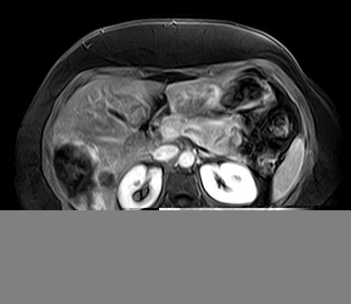 Hepatic Hemangioma - CTisus CT Scan