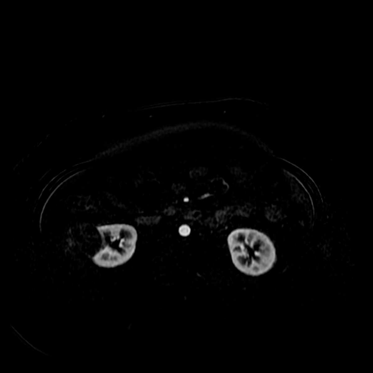 Multilocular cystic nephroma of the kidney - CTisus CT Scan