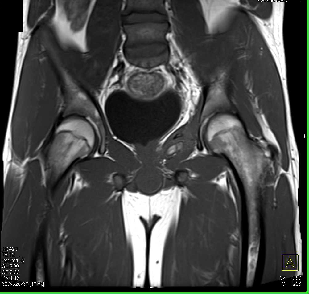 Ewing Sarcoma in the Pelvis - CTisus CT Scan