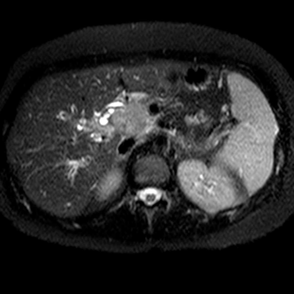 Distal Common Bile Duct (CBD) Cholangiocarcinoma - CTisus CT Scan