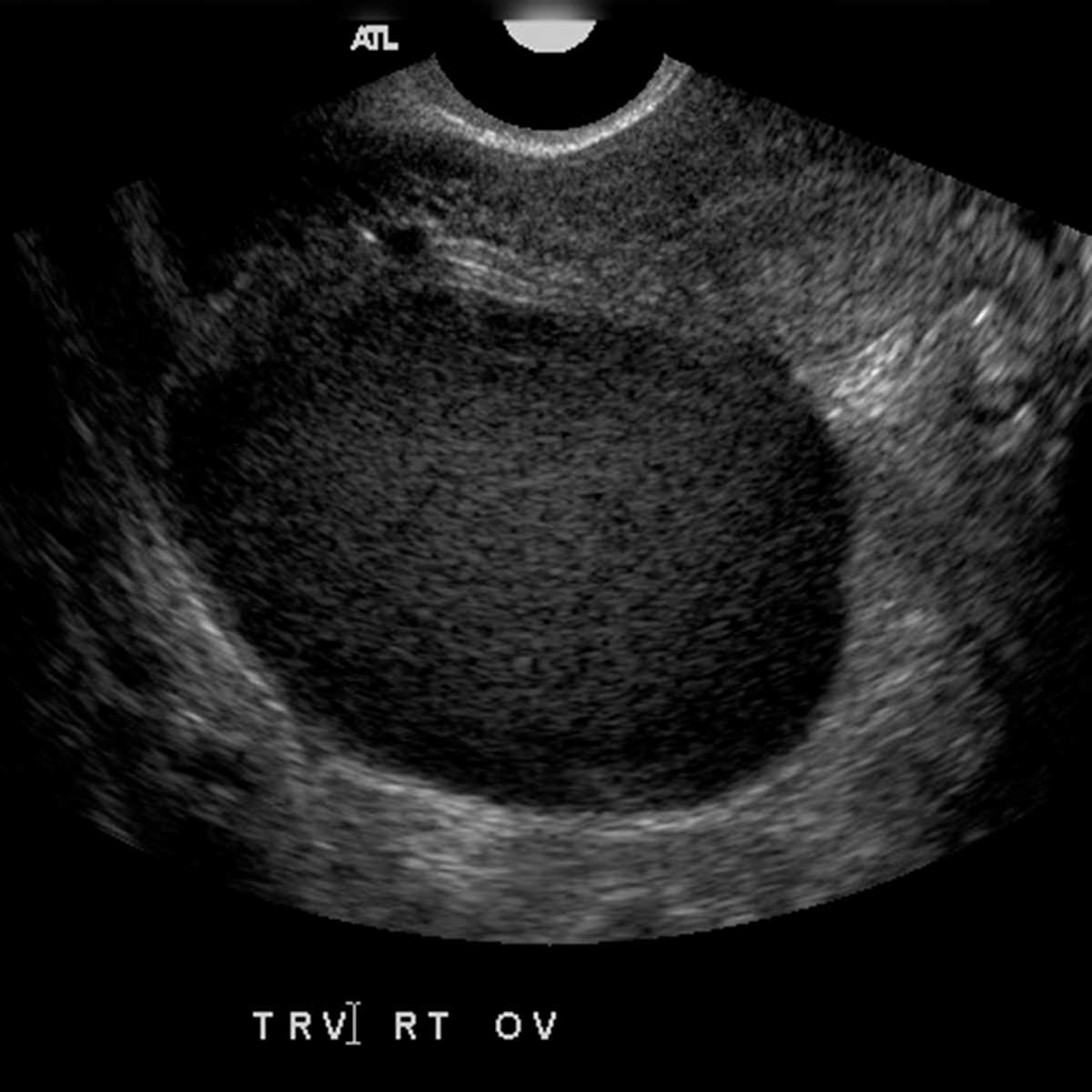 Endometrioma - CTisus CT Scan