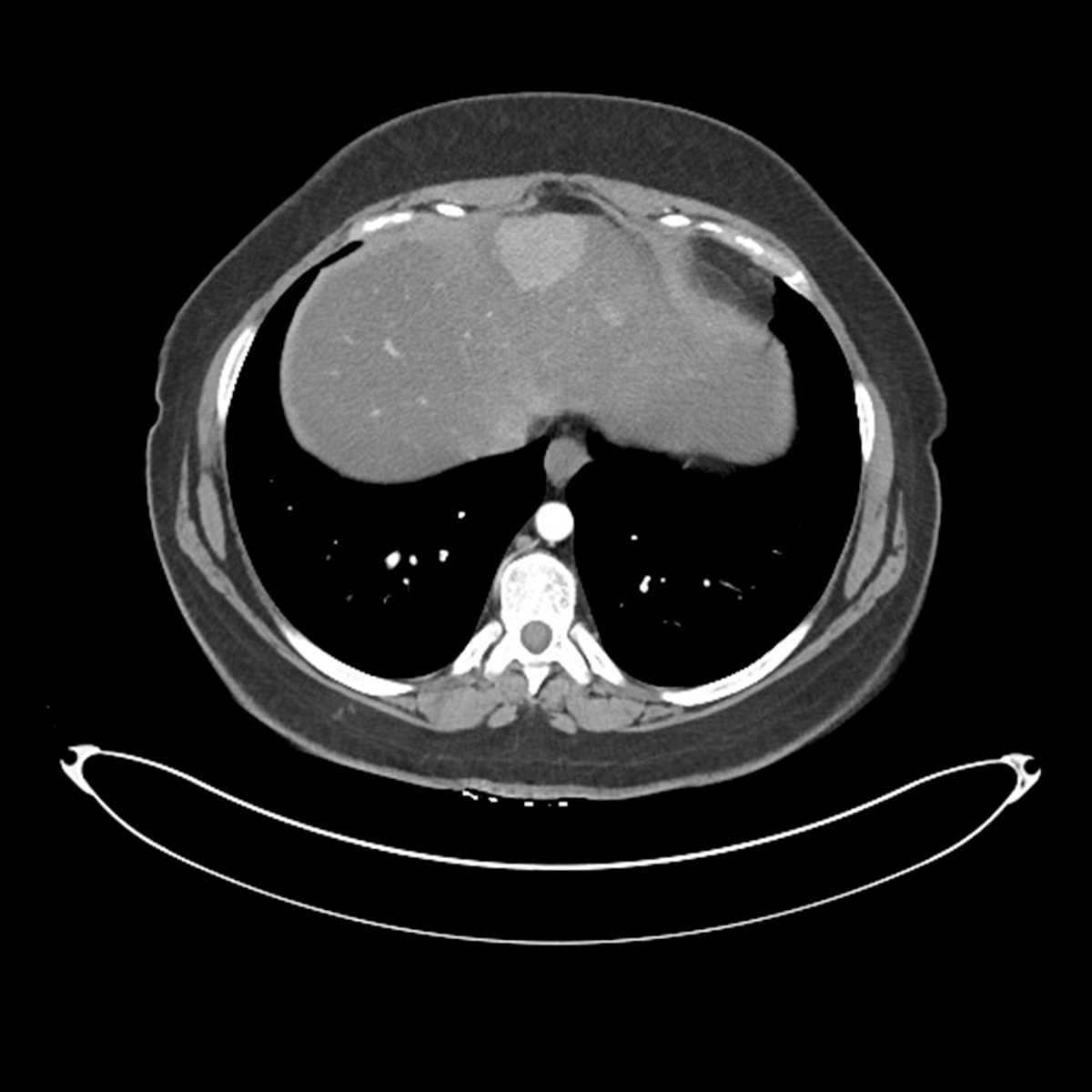 Hepatic adenomatosis - CTisus CT Scan