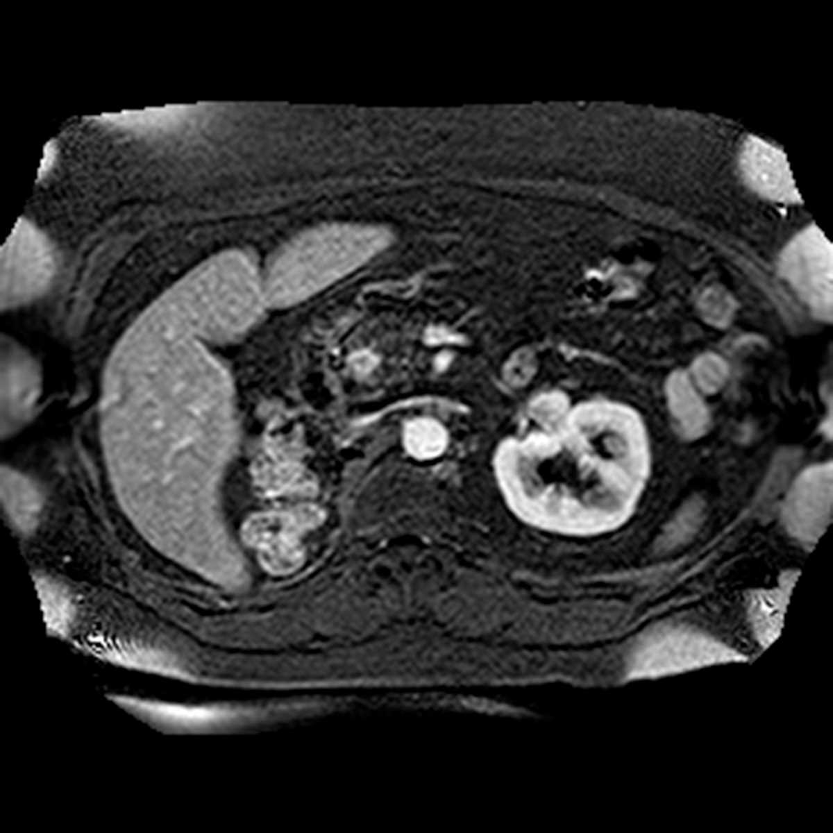 Metastatic renal cell carcinoma to the pancreas - CTisus CT Scan