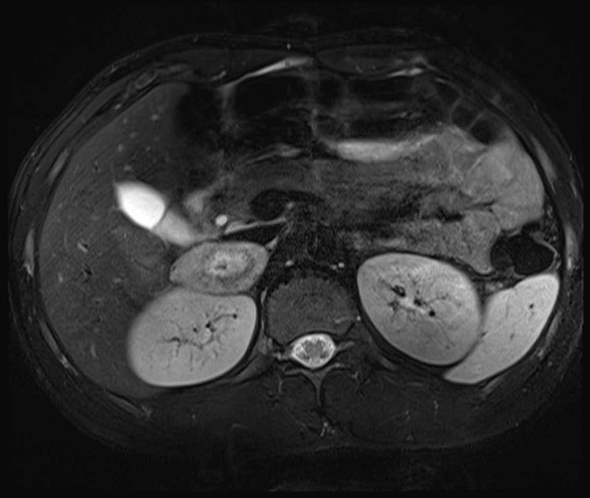 Pheochromocytoma - CTisus CT Scan