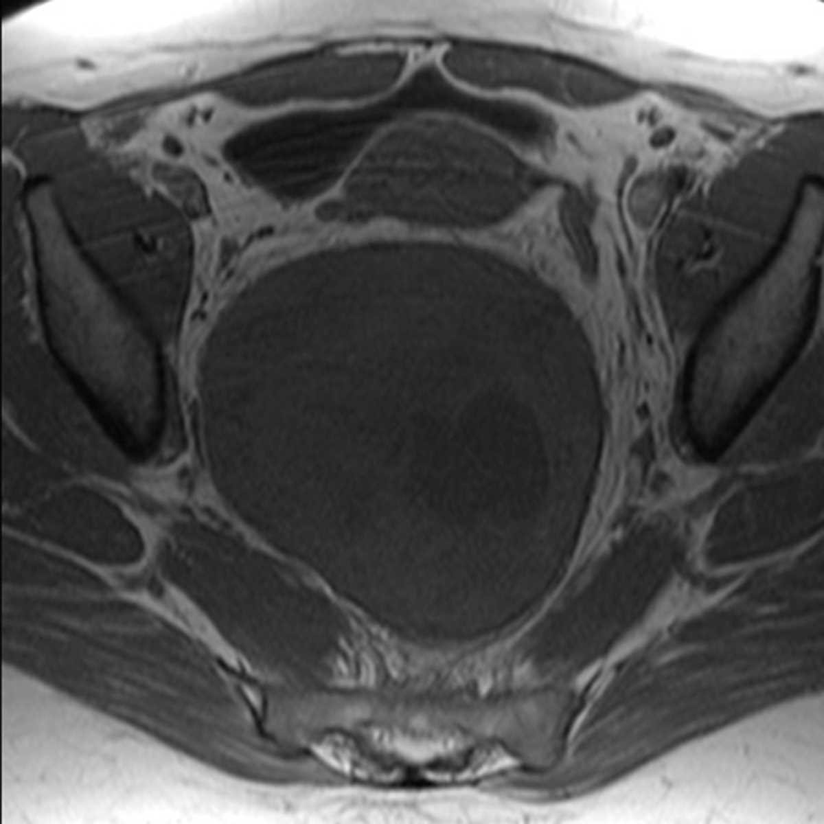 Presacral schwannoma - CTisus CT Scan