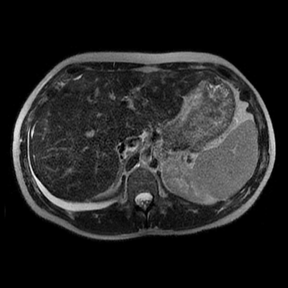 Pseudocirrhosis - CTisus CT Scan