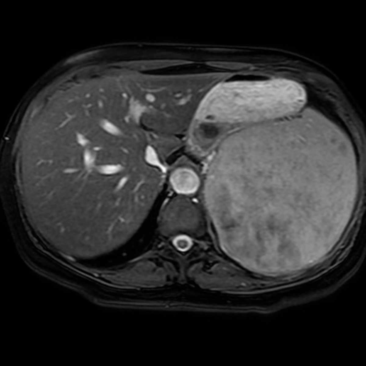 Splenic angiosarcoma - CTisus CT Scan