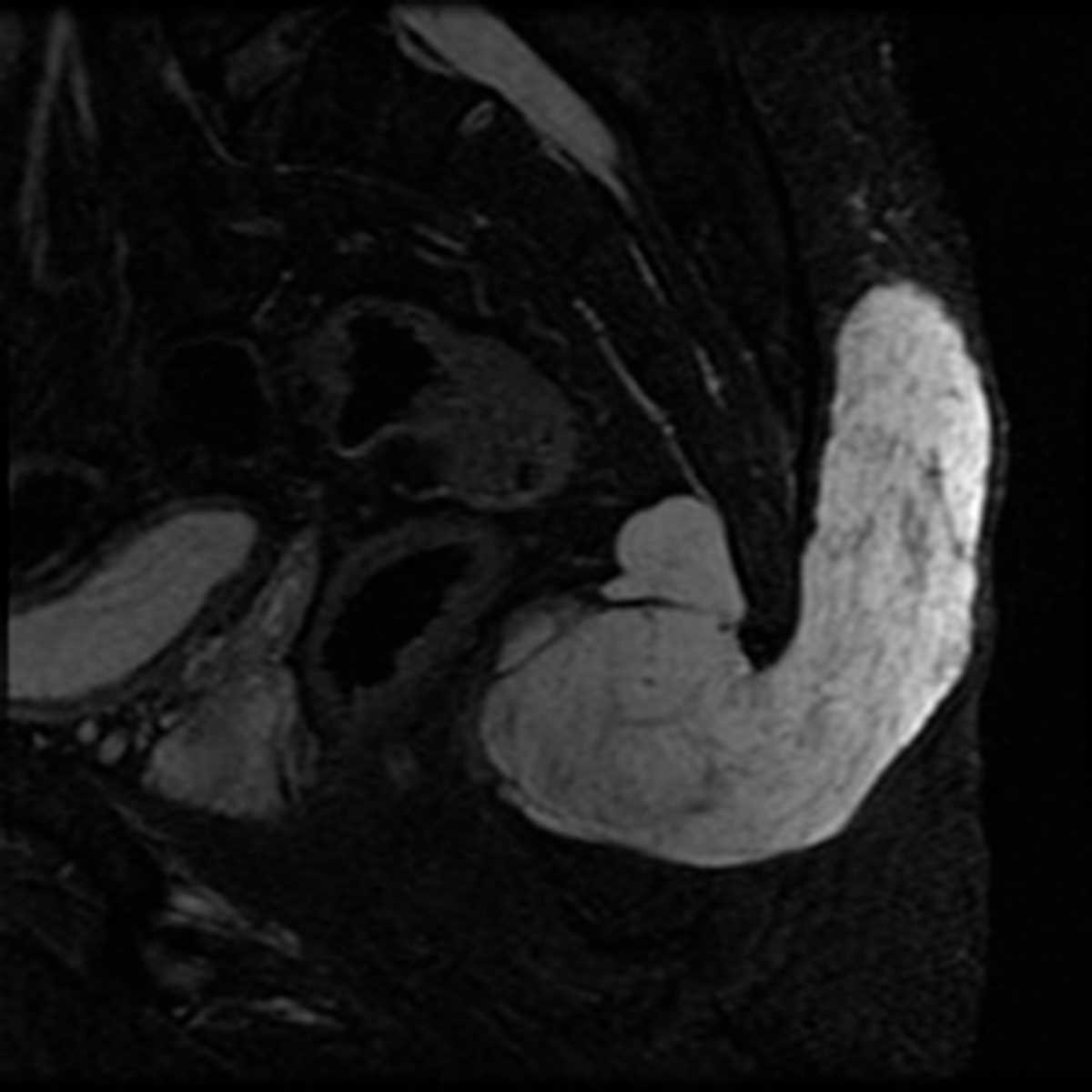 Chordoma - CTisus CT Scan