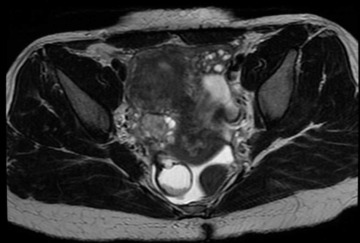 Endometrioma - CTisus CT Scan