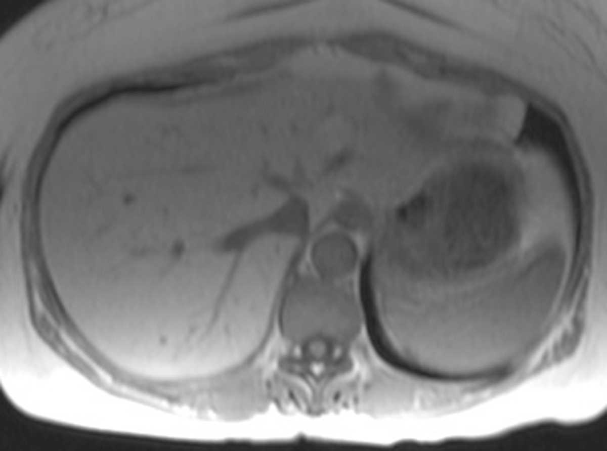 Hepatic Steatosis - CTisus CT Scan