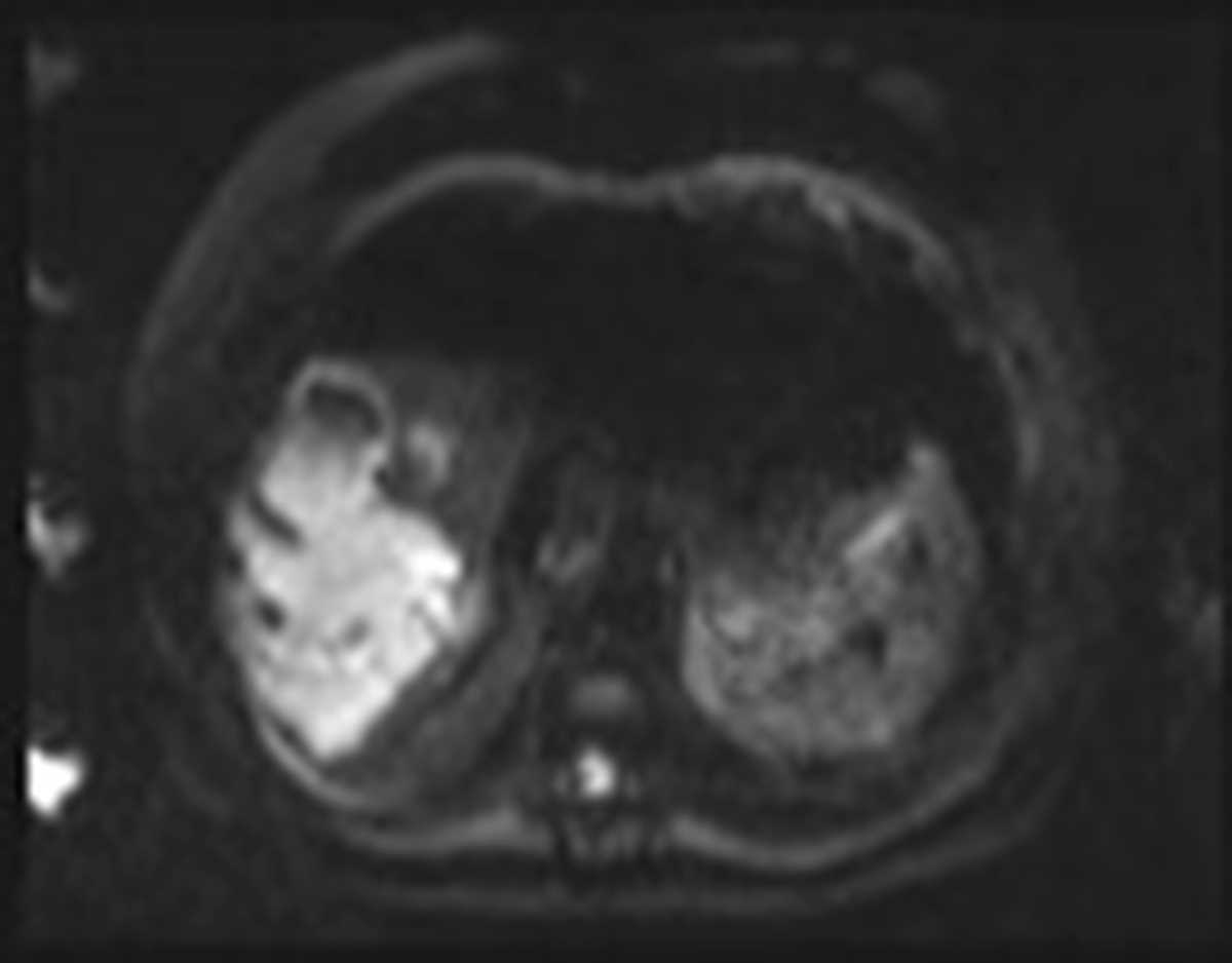 Liver Abscess - CTisus CT Scan