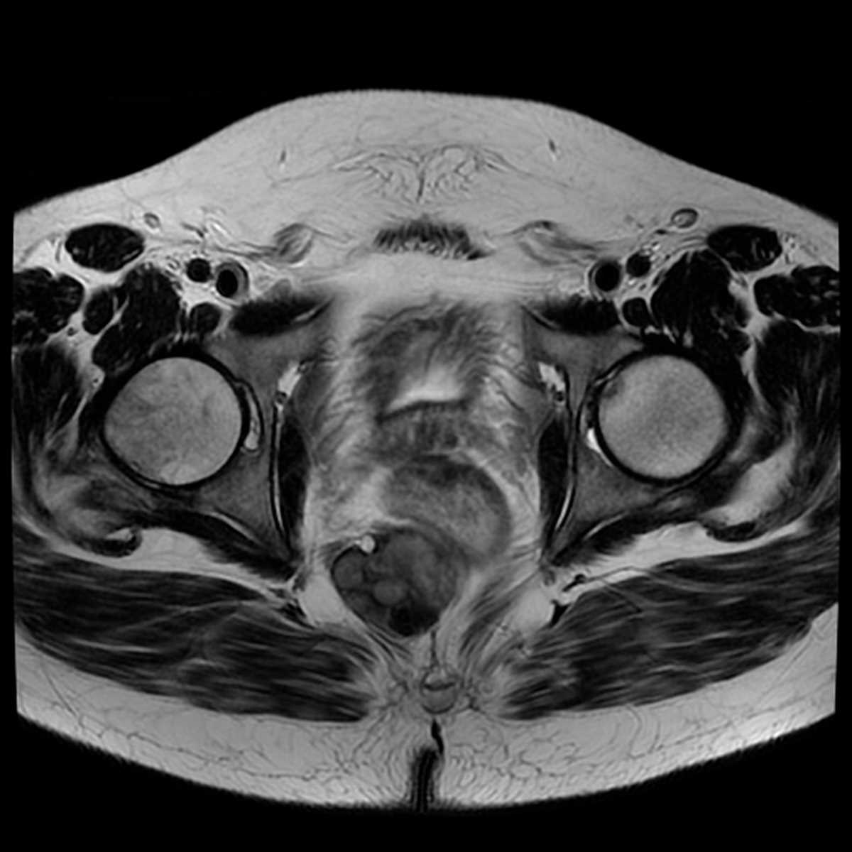 Perirectal fibrosarcoma - CTisus CT Scan