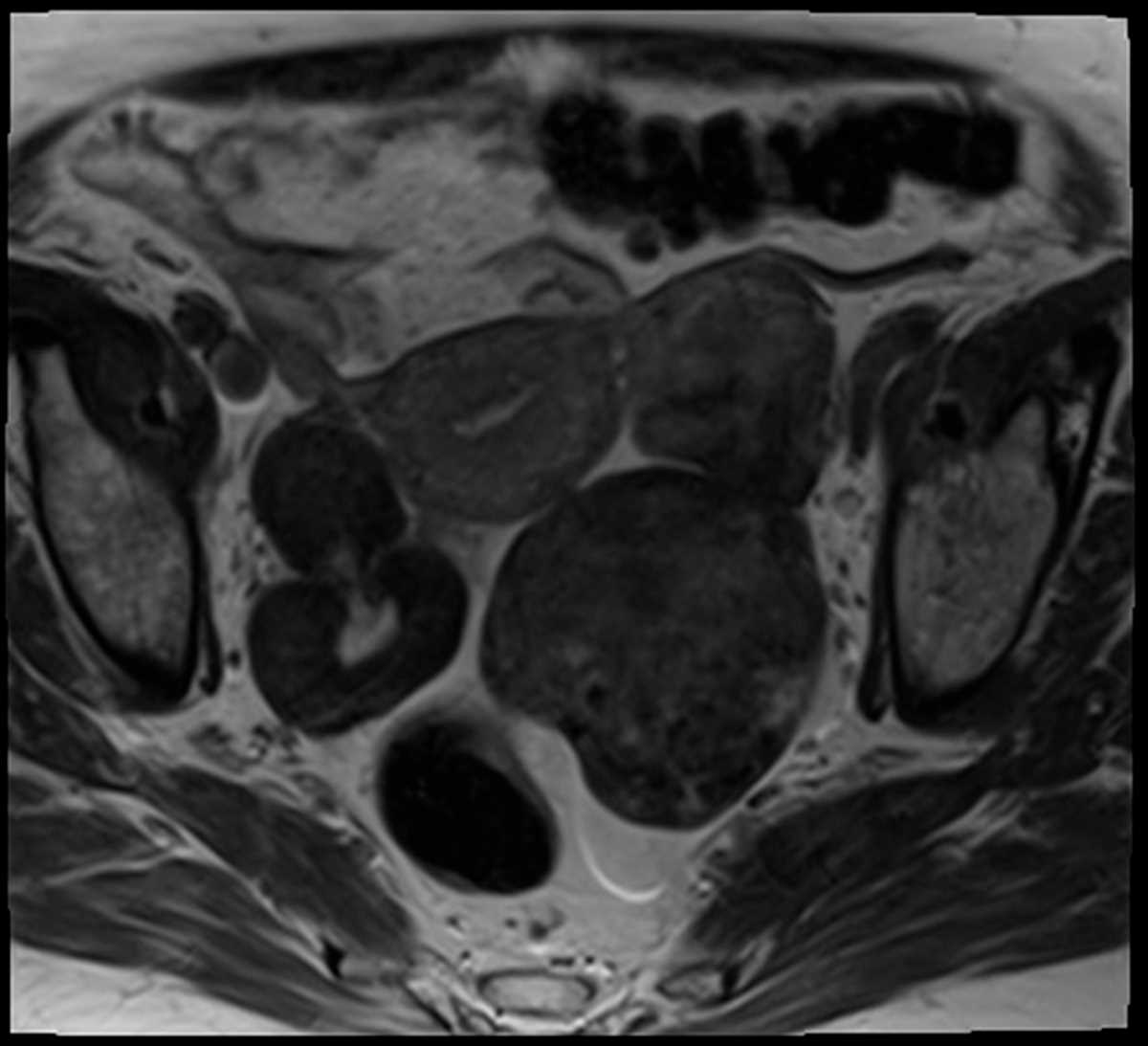 Solid ovarian masses - CTisus CT Scan