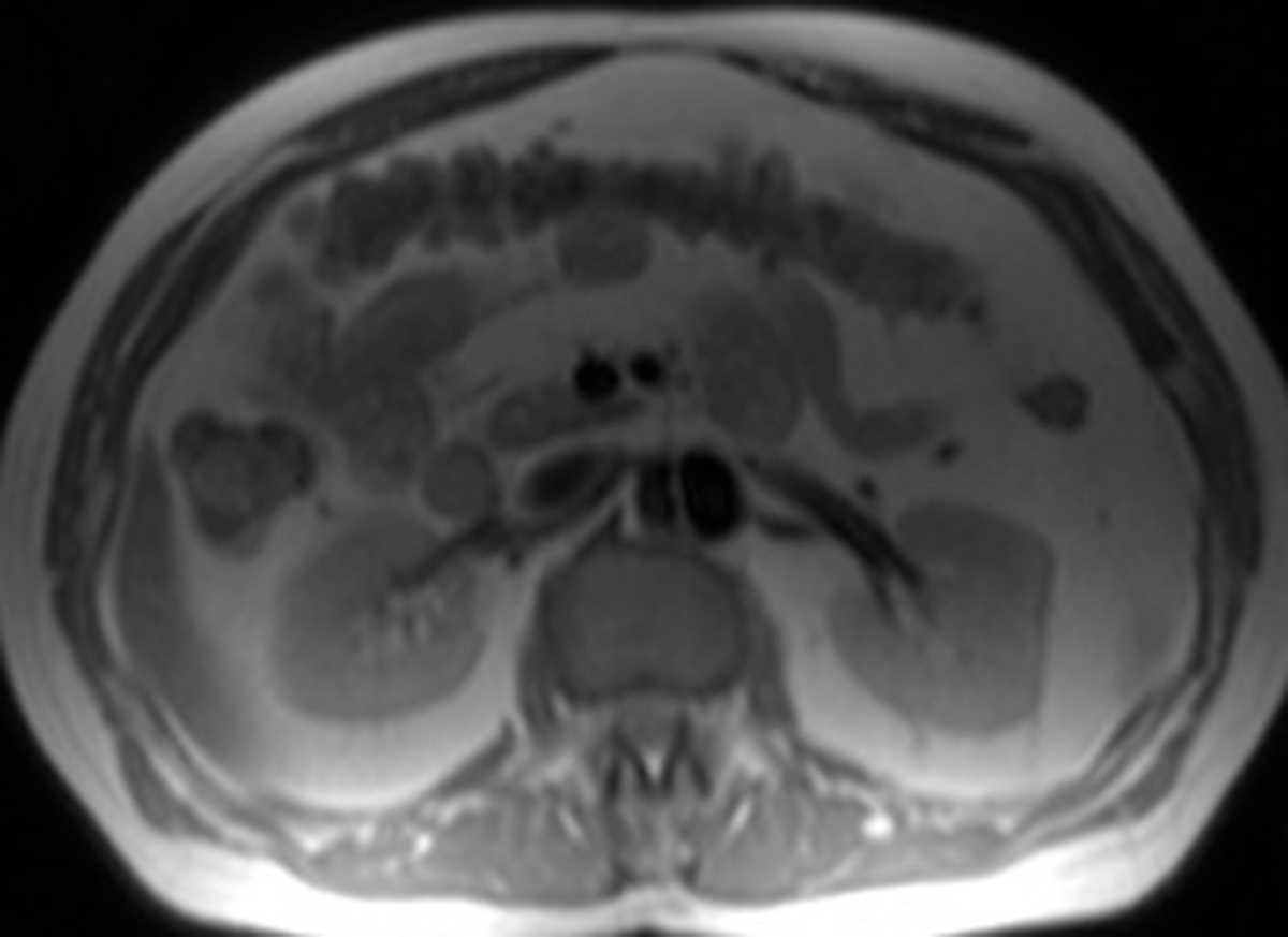 Aortic dissection - CTisus CT Scan