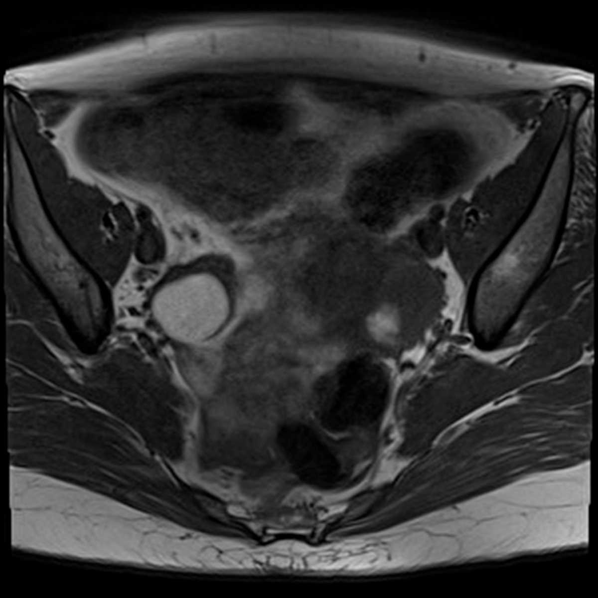 Bilateral endometriomas - CTisus CT Scan