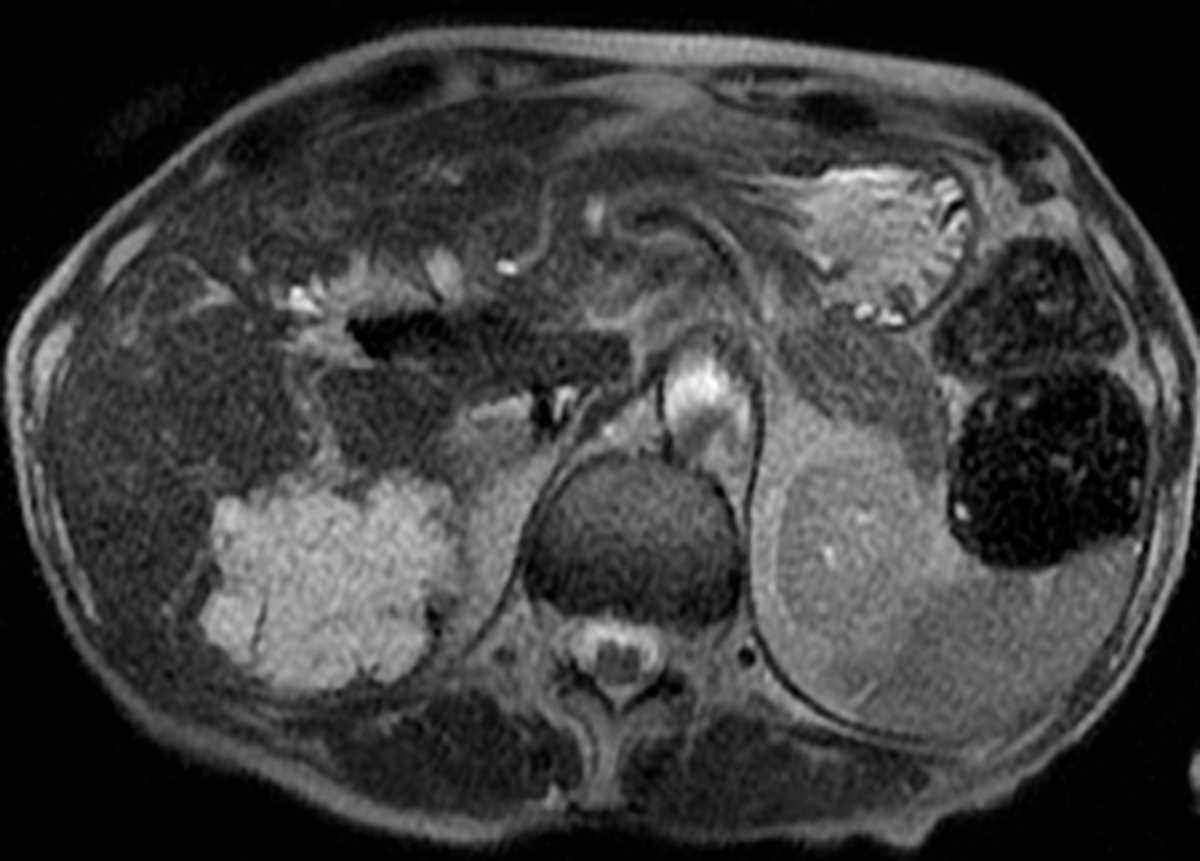 Colon cancer metastasis - CTisus CT Scan