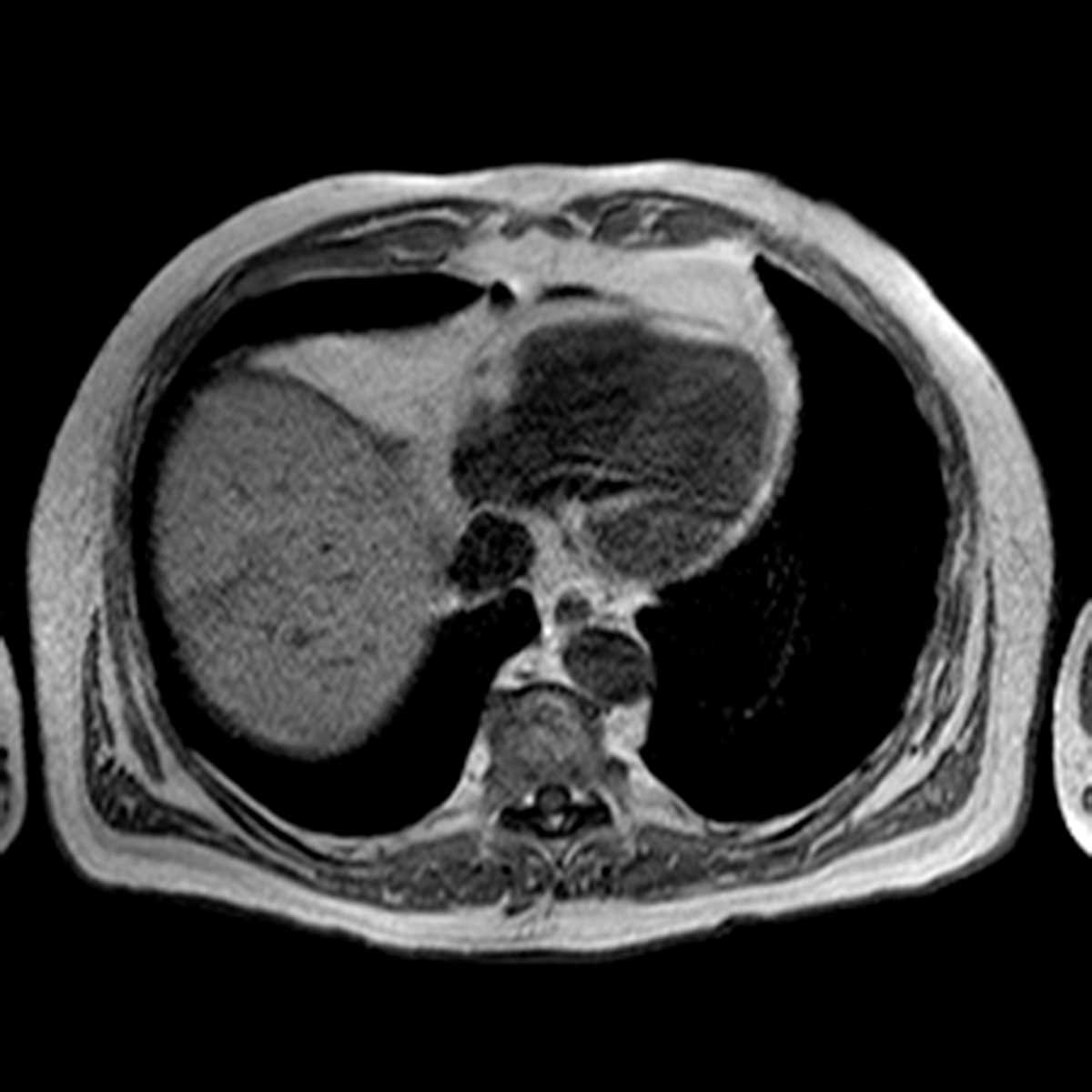 Focal fatty sparing of liver - CTisus CT Scan