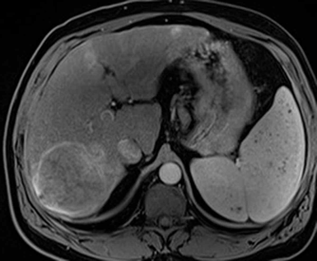 Hepatocellular Carcinoma (Hepatoma) (HCC) - CTisus CT Scan