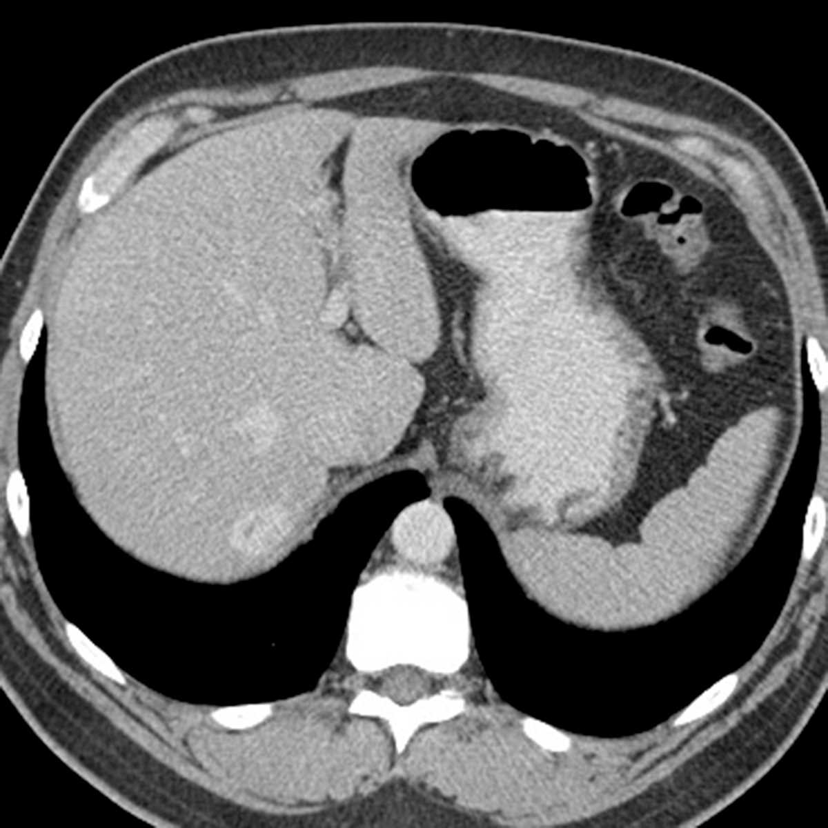 Hemangioma - CTisus CT Scan