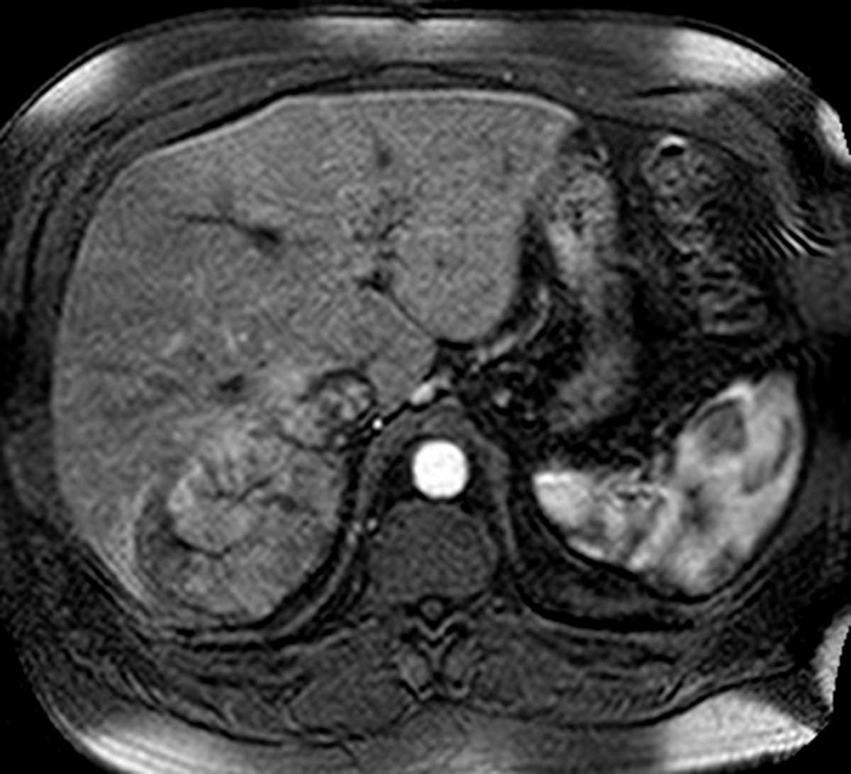 Hepatocellular Carcinoma (Hepatoma) after chemoembolization - CTisus CT Scan