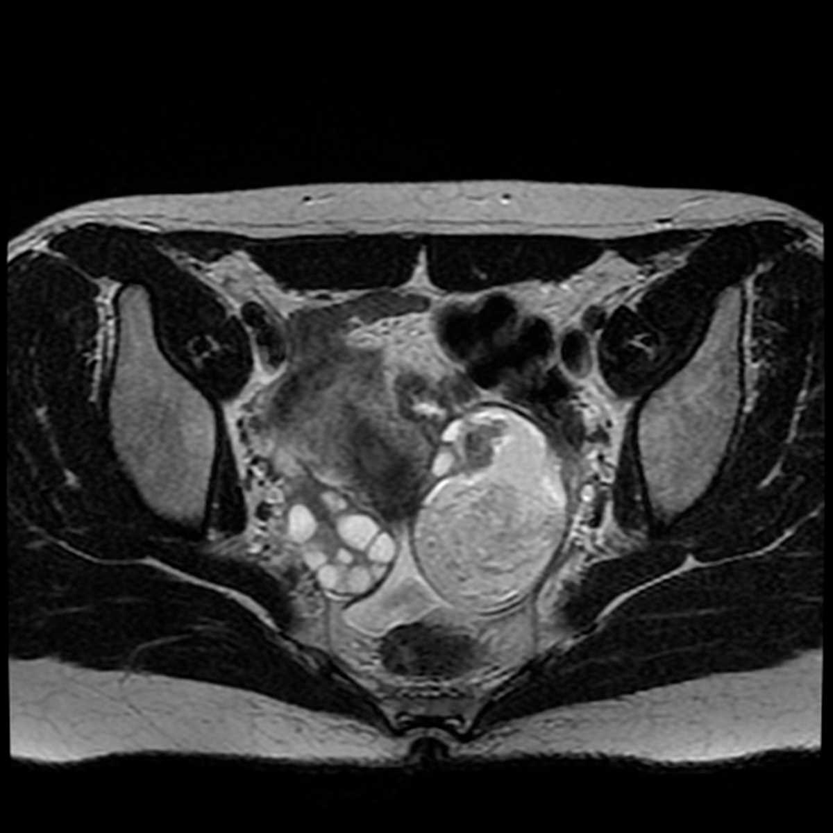 Ovarian dermoid - CTisus CT Scan