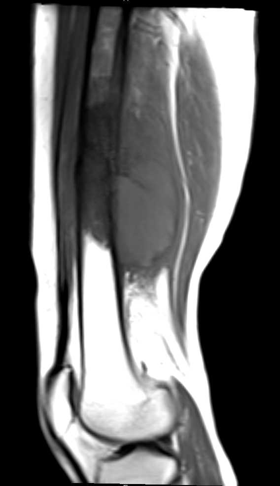 Lymphoma of Bone with Multiple Sites of Involvement - CTisus CT Scan