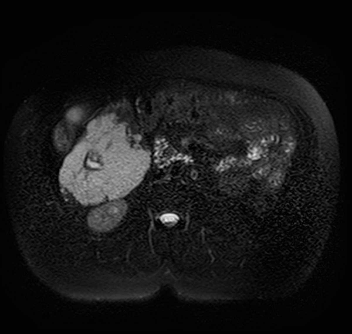 Giant liver hemangioma with central scar - CTisus CT Scan