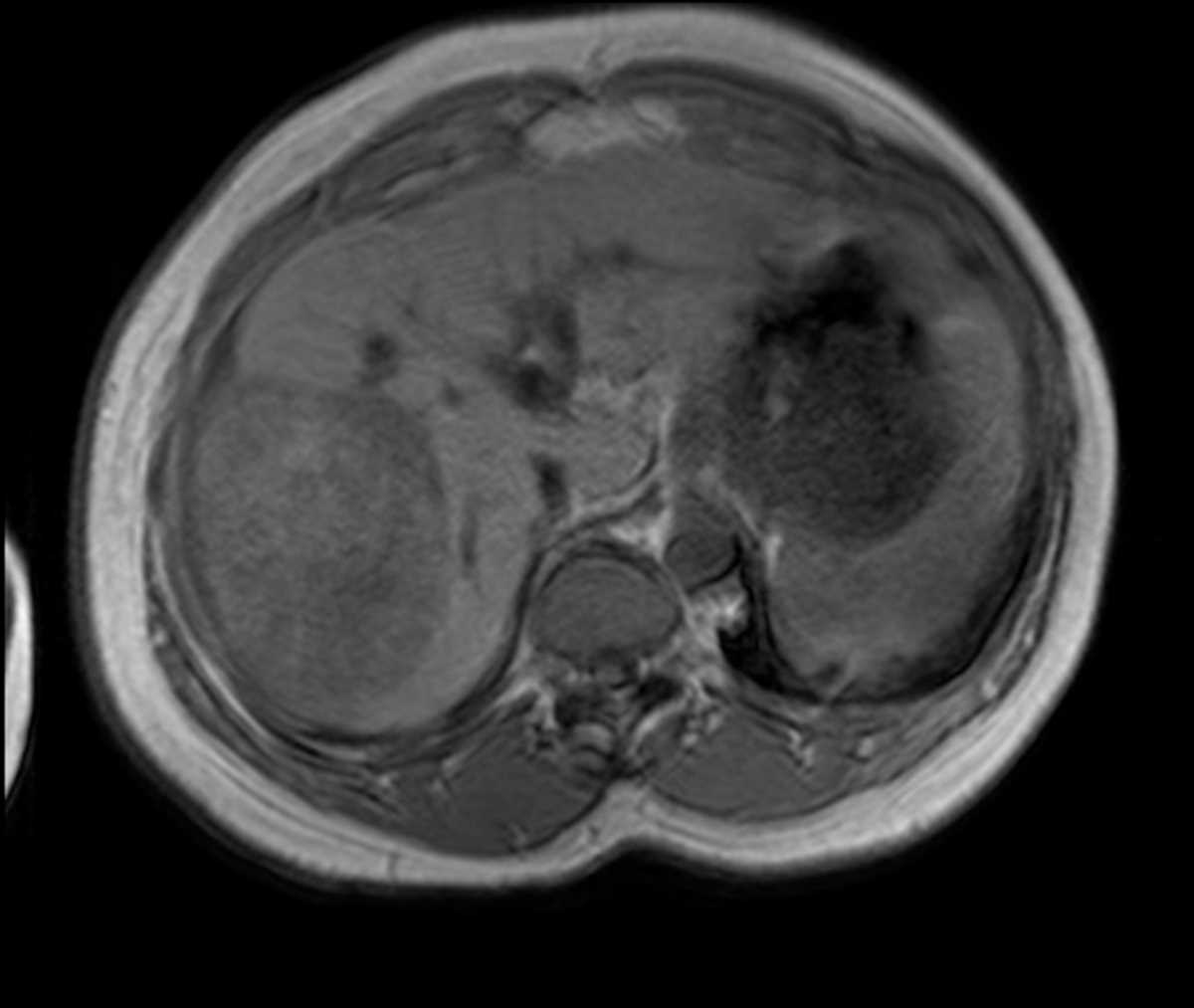 Hepatocellular Carcinoma (Hepatoma) (HCC) with intracellular fat - CTisus CT Scan