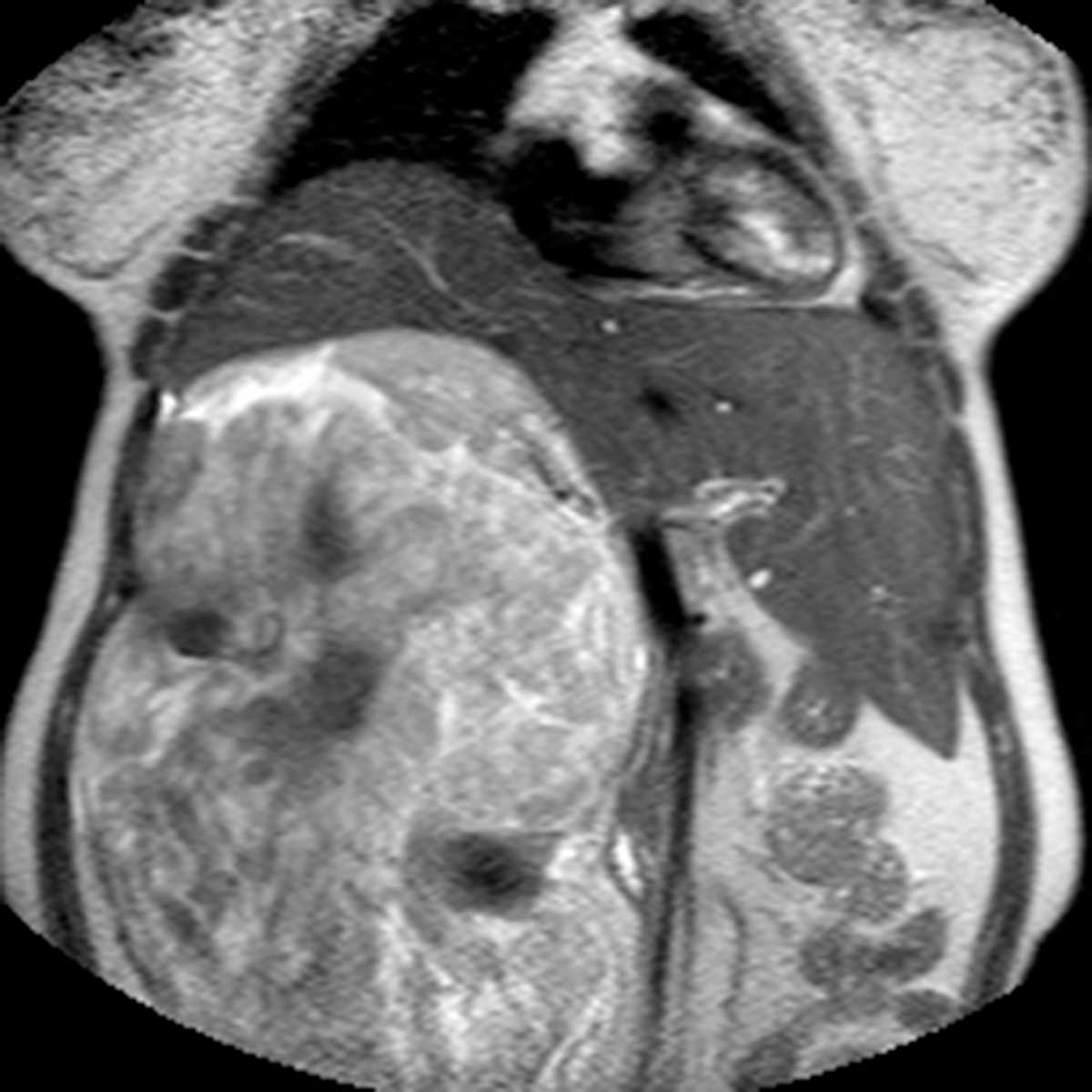 Retroperitoneal Liposarcoma - CTisus CT Scan