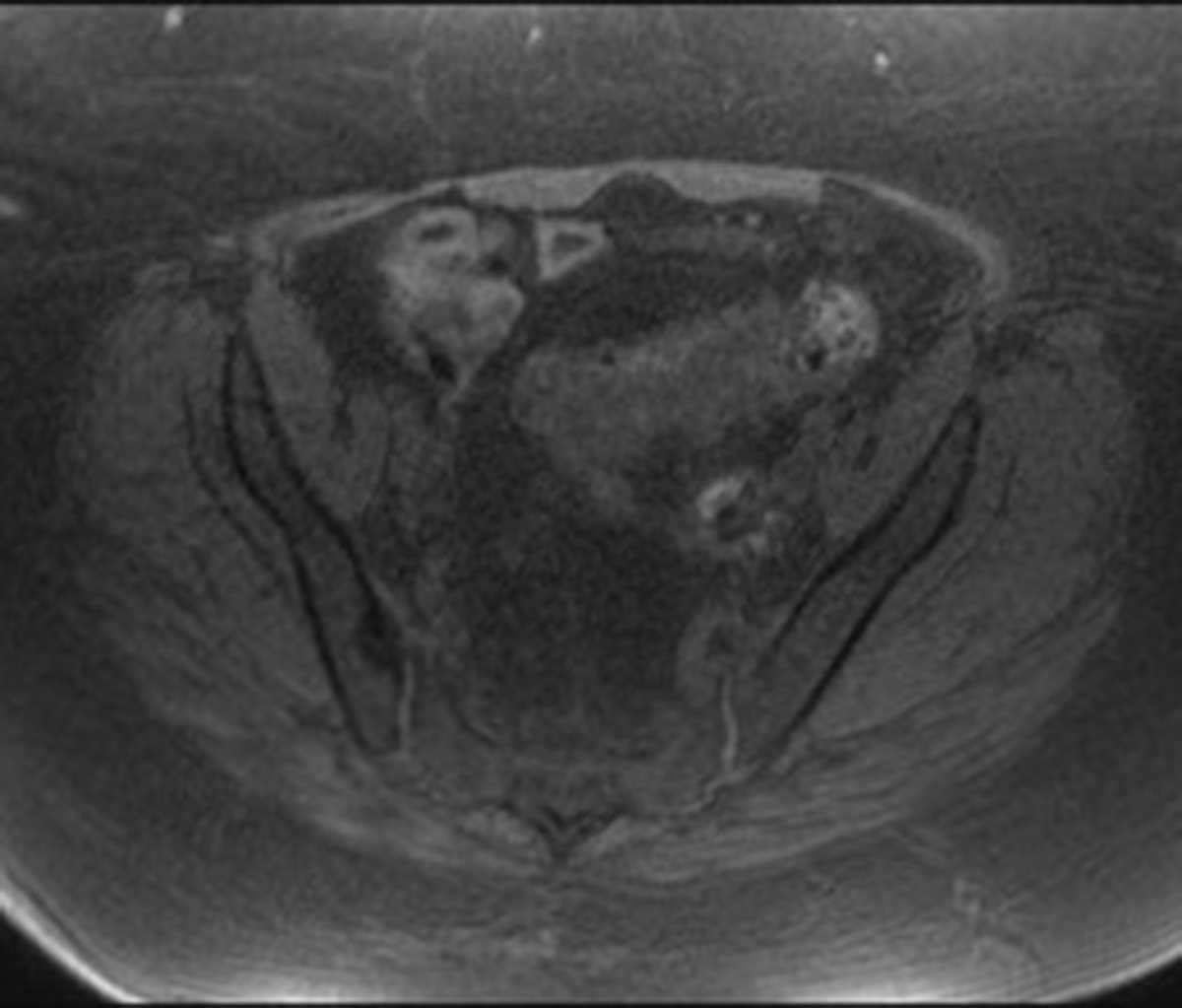 Acute diverticulitis - CTisus CT Scan