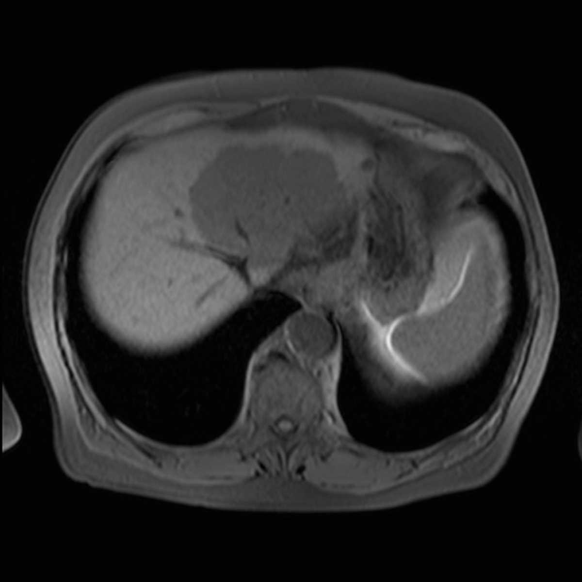 Cholangiocarcinoma - CTisus CT Scan