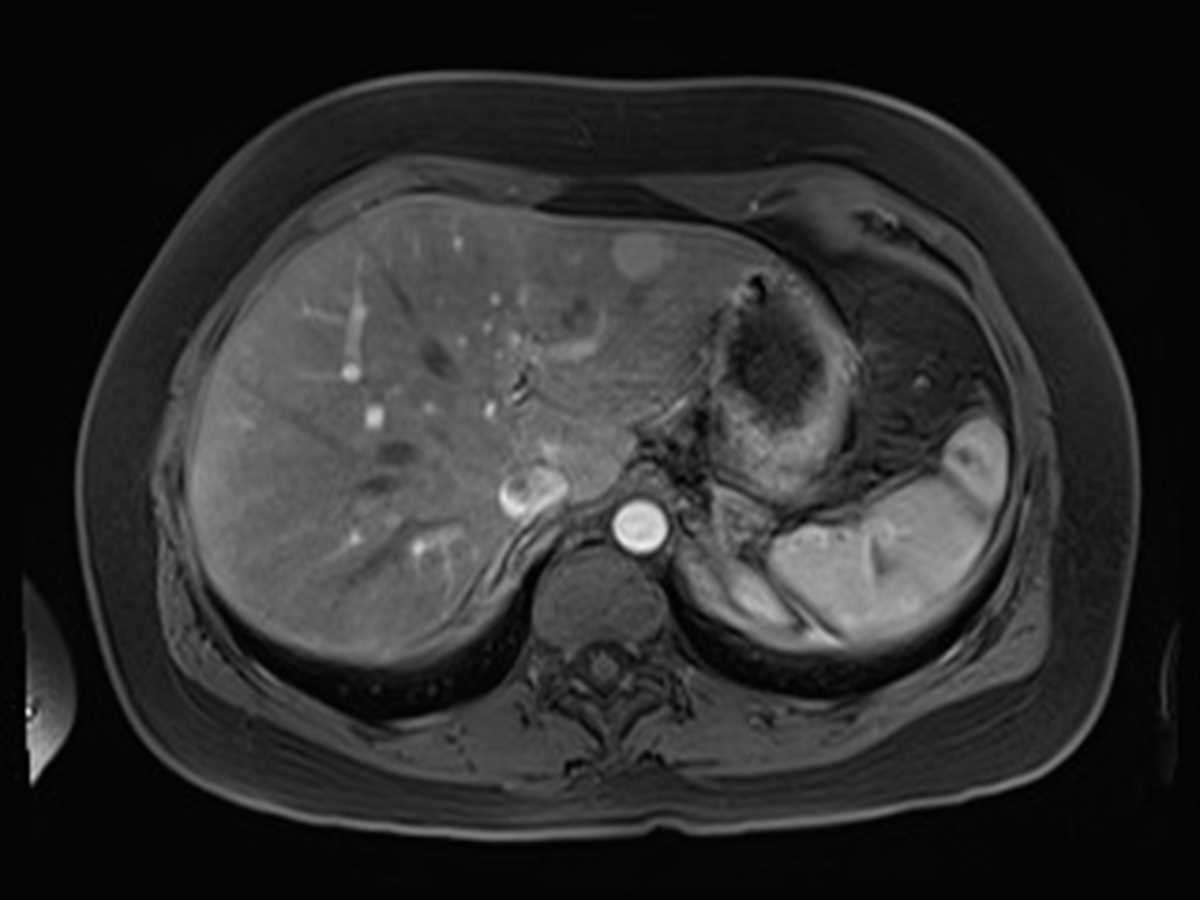 Hepatic adenomatosis with Eovist MRI - CTisus CT Scan