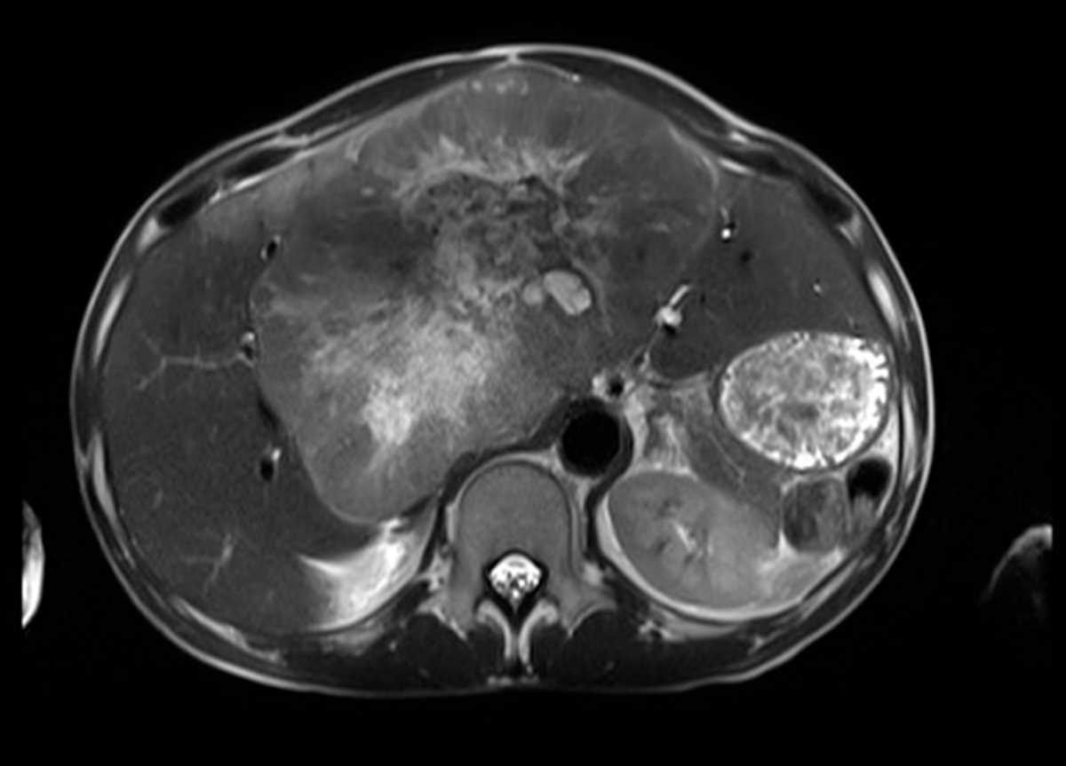 Large Hepatocellular Carcinoma (Hepatoma) - CTisus CT Scan