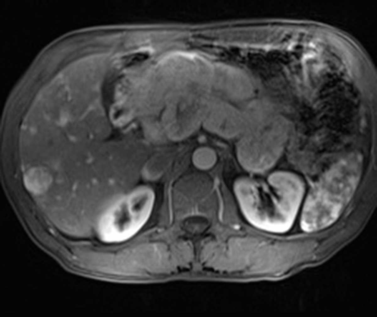 Large pancreatic neuroendocrine tumor - CTisus CT Scan