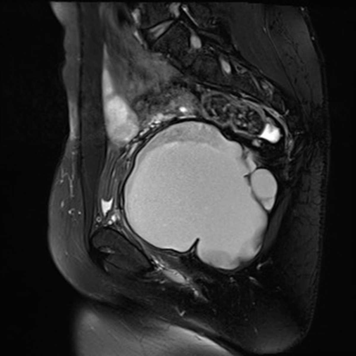 Pelvic tailgut cyst - CTisus CT Scan