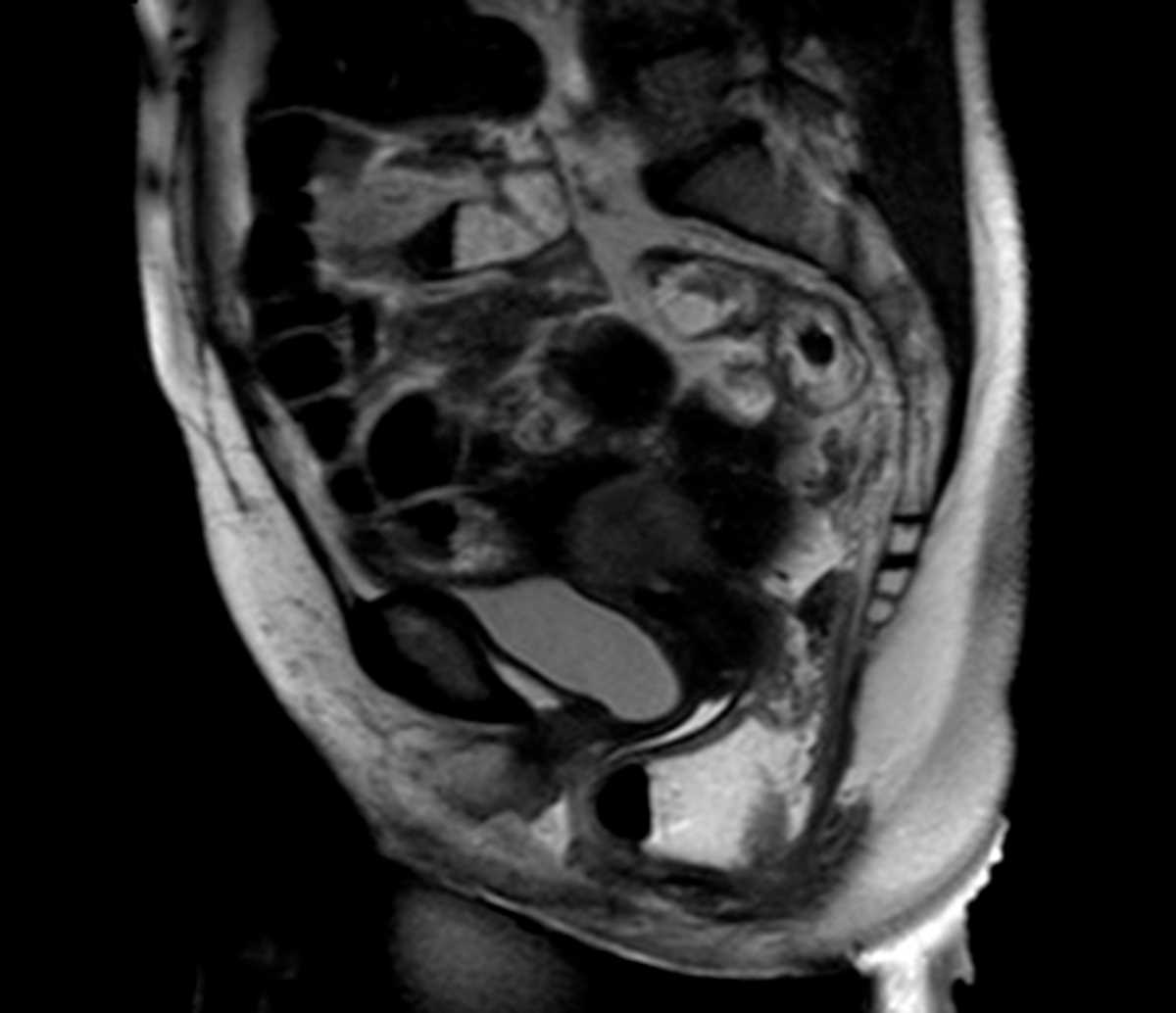 Pelvic floor dysfunction - CTisus CT Scan