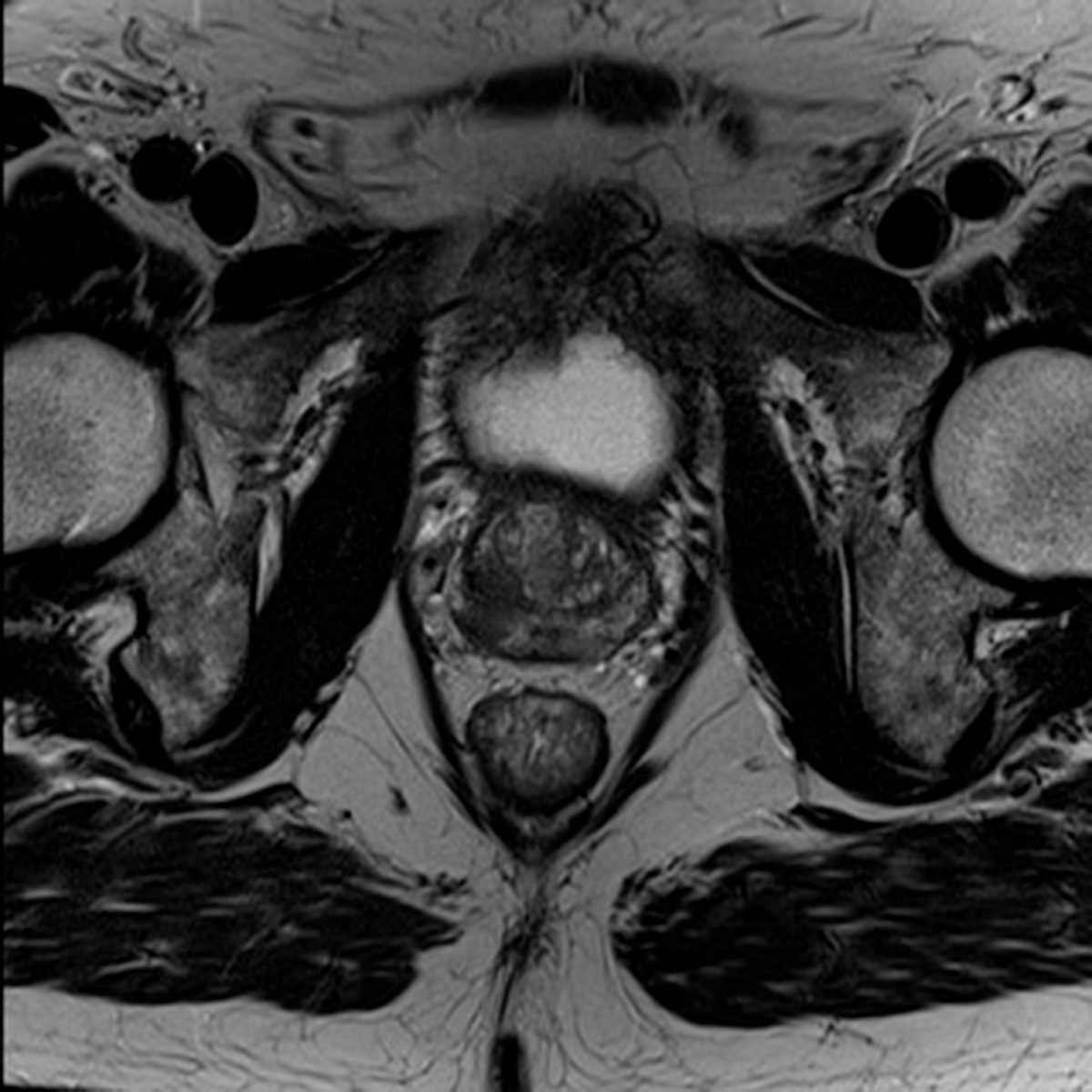 Prostate Cancer - CTisus CT Scan