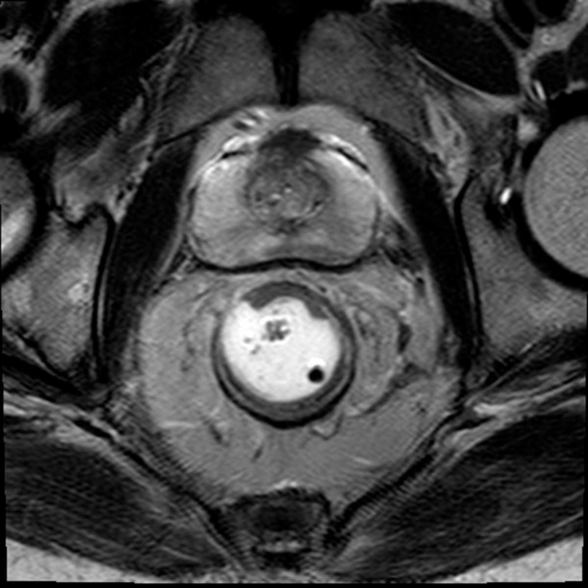 Rectal cancer - CTisus CT Scan