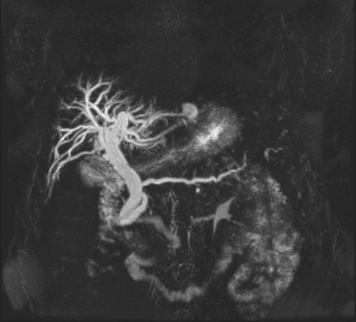 Ampullary carcinoma - CTisus CT Scan