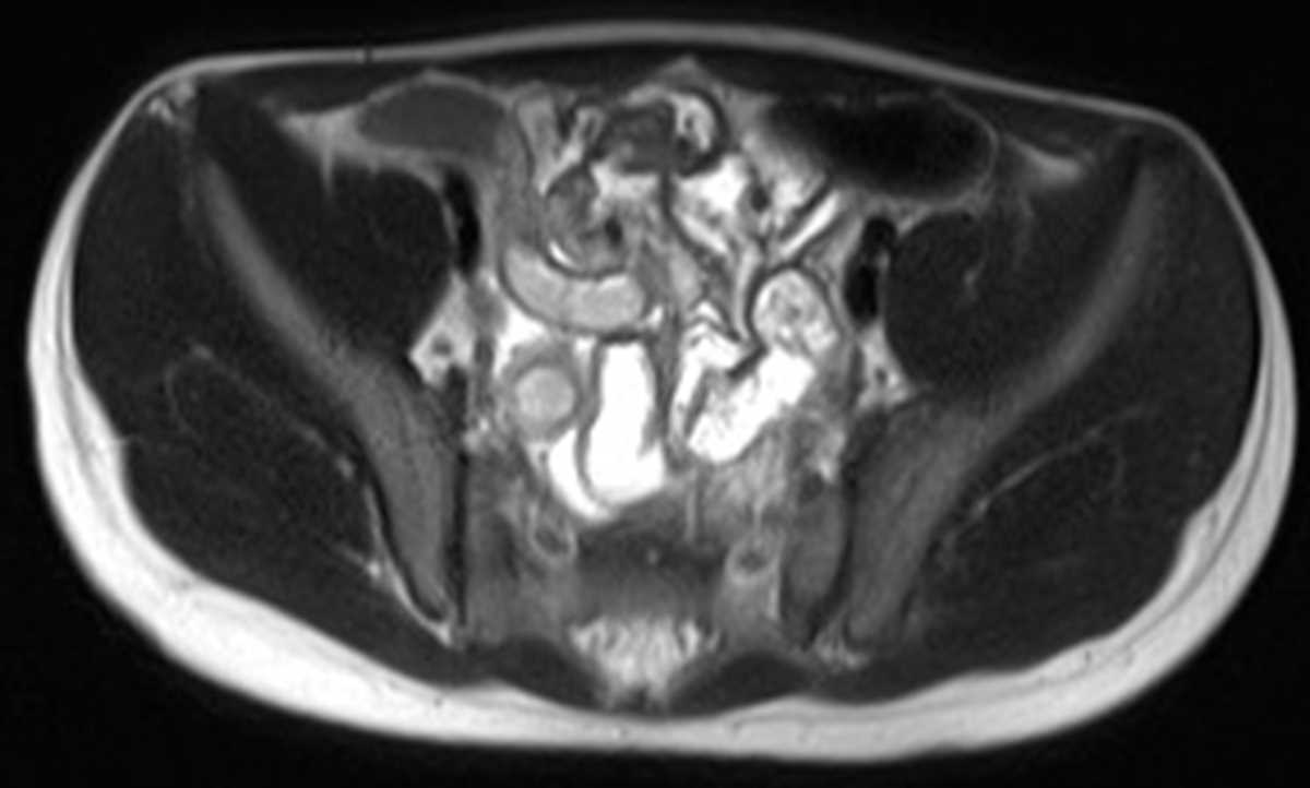 Appendicitis - CTisus CT Scan