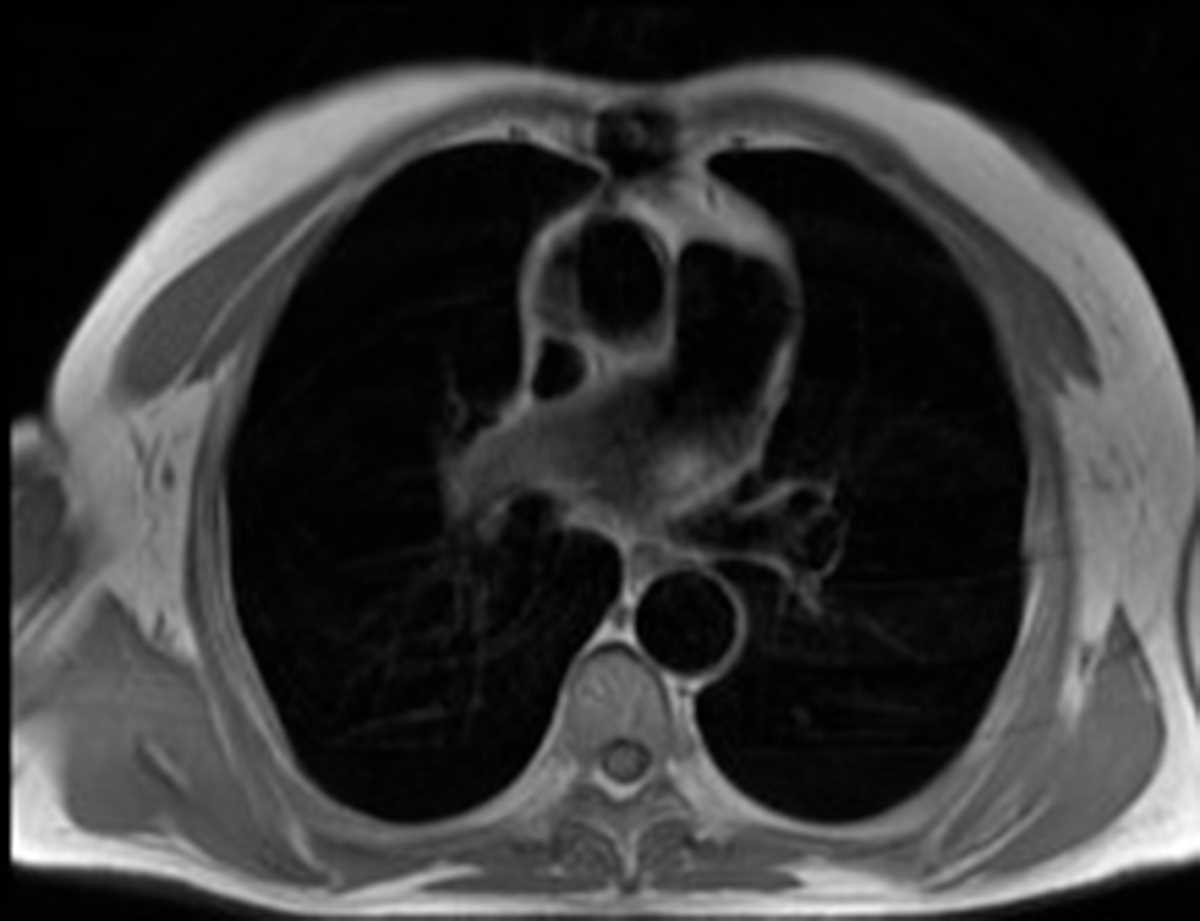 Ascending aortic pseudoaneurysm after graft repair - CTisus CT Scan