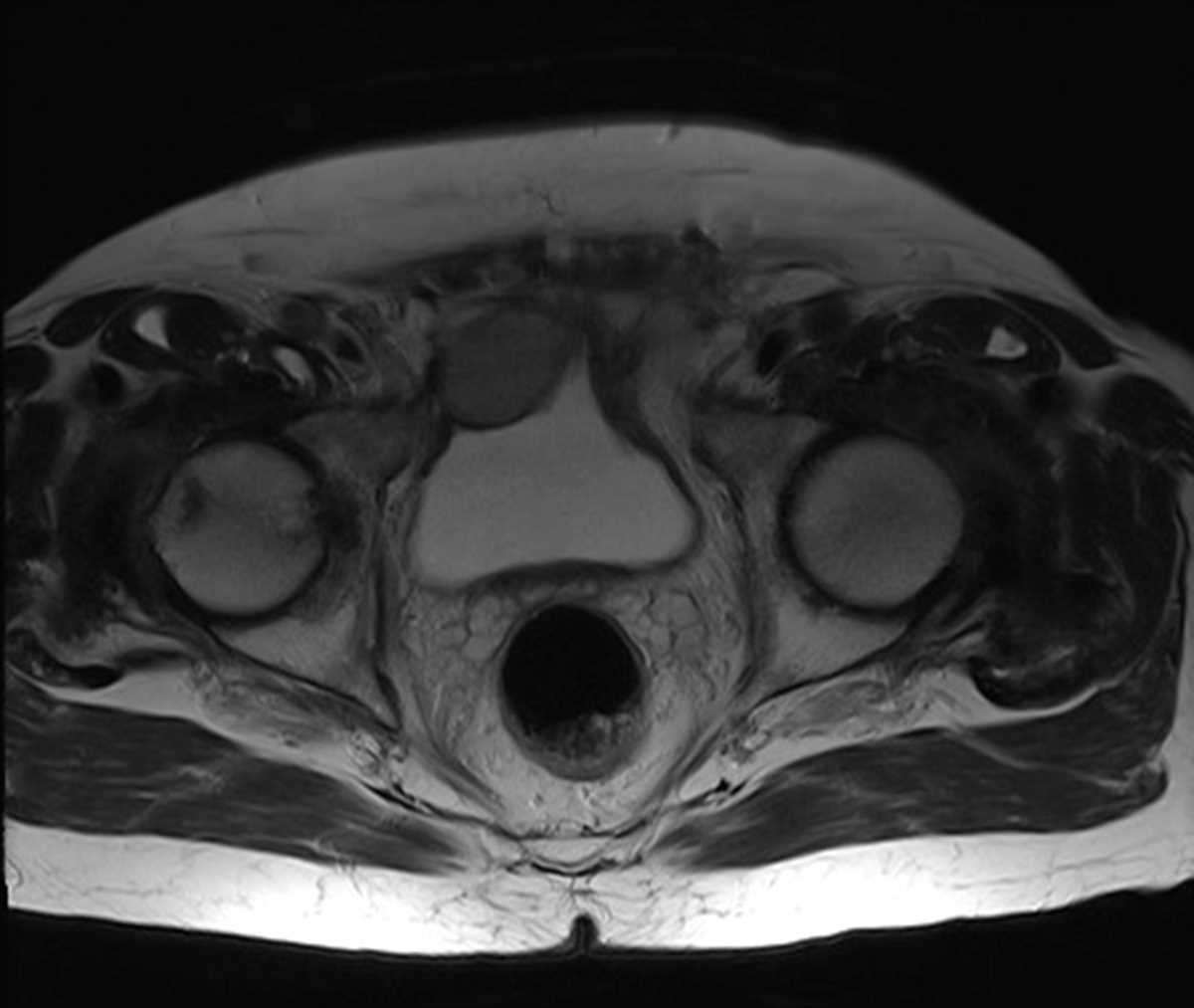 Bladder cancer with lymphadenopathy - CTisus CT Scan