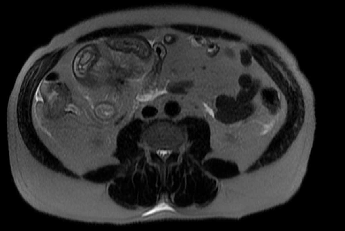 Carcinoid tumor in mesentery with desmoplastic reaction - CTisus CT Scan