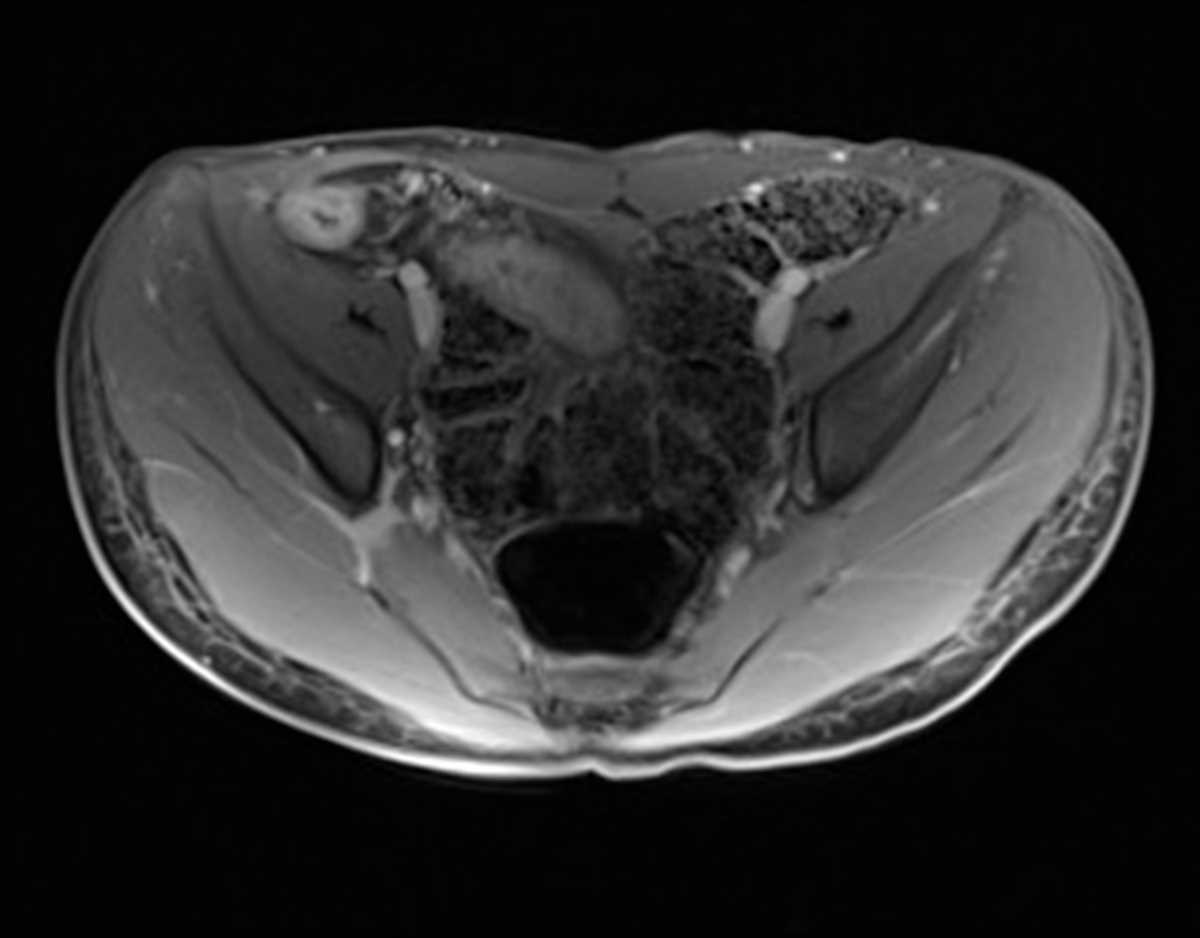 Crohn's ileitis - CTisus CT Scan