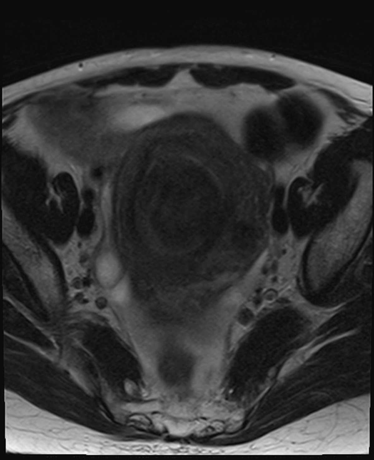 Intracavitary fibroid - CTisus CT Scan