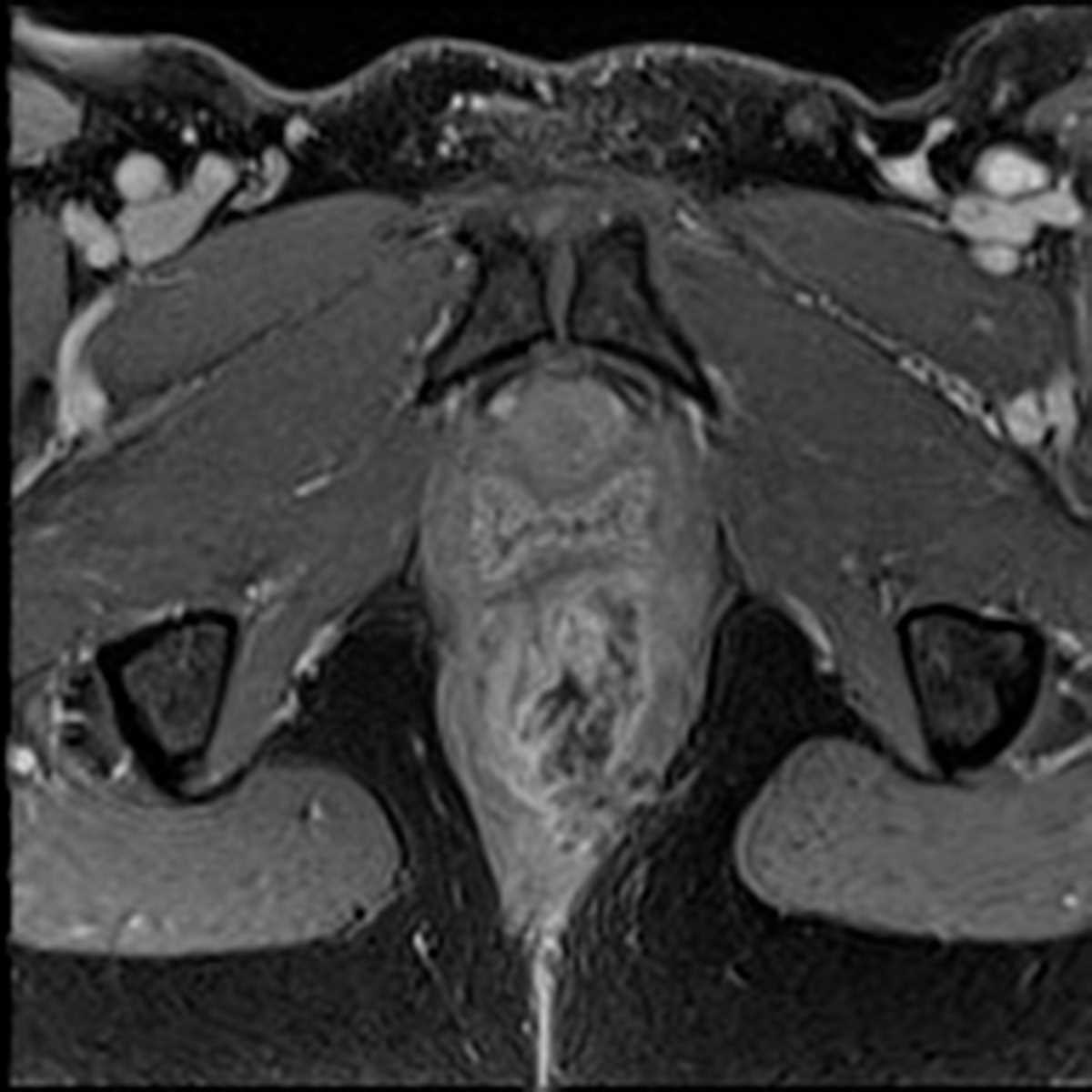 Rectal cancer with involvement of sphincters - CTisus CT Scan