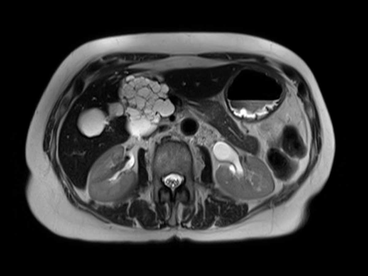 Serous cystadenoma of the pancreas - CTisus CT Scan