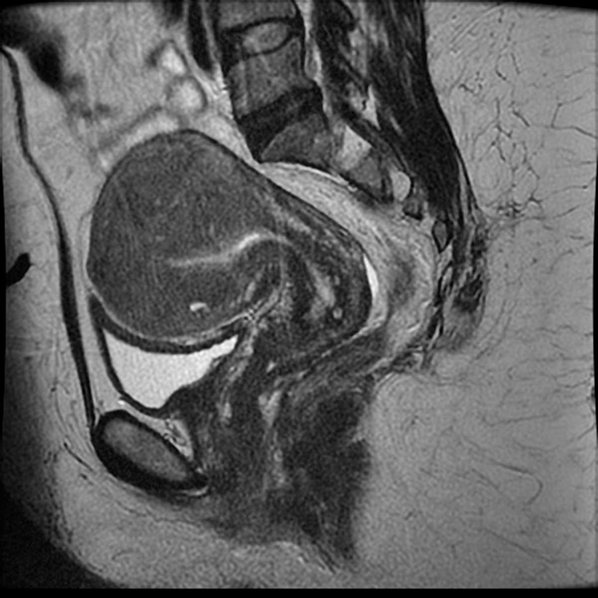 Adenomyosis - CTisus CT Scan