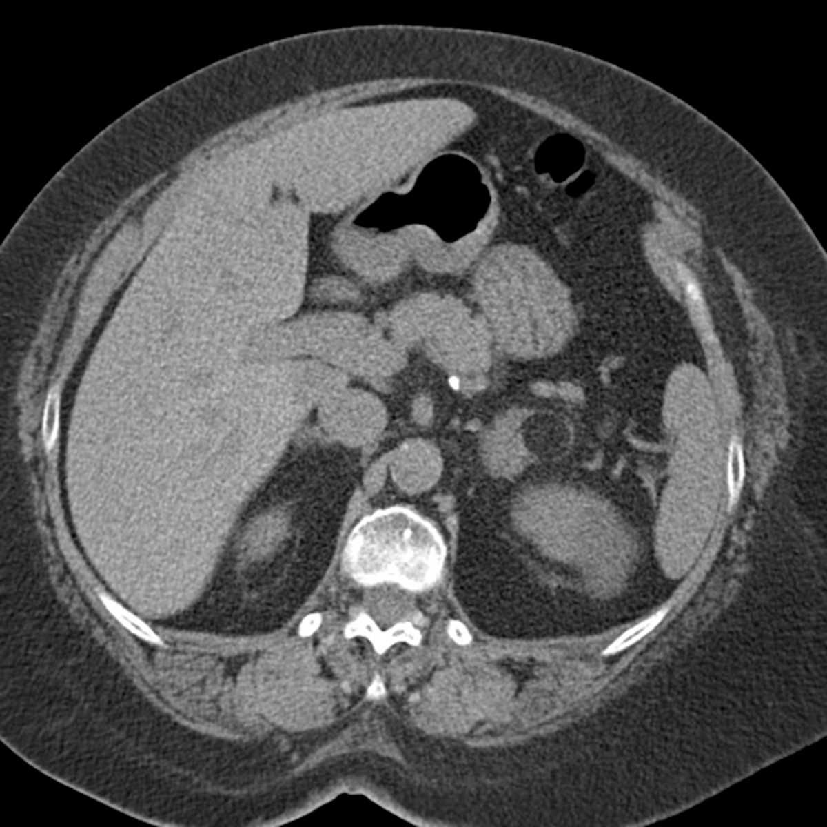 Adrenal myelolipoma - CTisus CT Scan